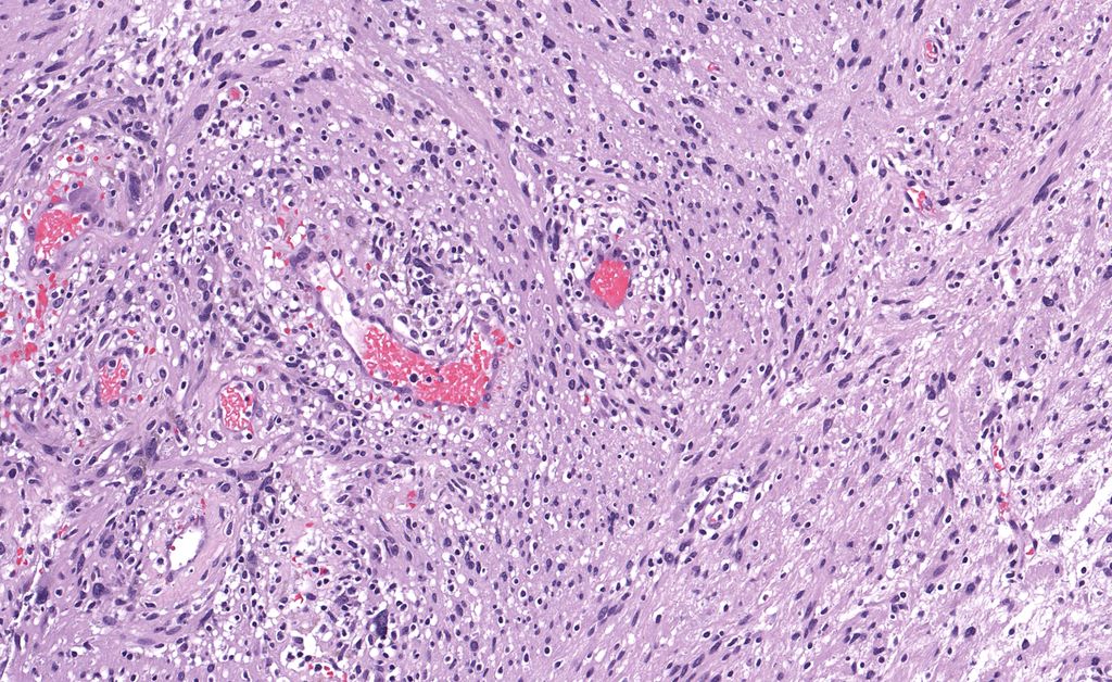 JMGardnerMD's tweet photo. 35 yo woman with 4 cm popliteal mass. Your diagnosis? 
Answer ✅  https://t.co/fJVUgseqgK 
Digital slide 🔬 https://t.co/OCtBu3Y8HH 
More info: https://t.co/L5VlQ2jIBq 
#pathology #pathologists #pathTwitter #dermpath #dermatology #dermtwitter #BSTpath https://t.co/92kZz0r0as