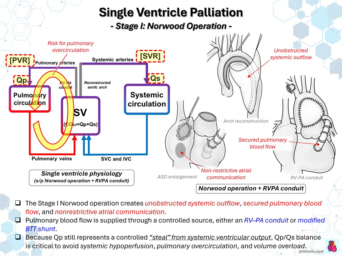 WithAScalpel's tweet photo. Single Ventricle Palliation #2: Norwood → Glenn → Fontan

👉Stage I Norwood secures systemic outflow, controlled pulmonary blood flow, and nonrestrictive atrial communication.
👉Stage II Glenn diverts SVC flow to the PAs, making pulmonary flow passive while reducing single-ventricle volume load.
👉Stage III Fontan directs systemic venous return to the PAs; low PVR and low atrial pressure are essential for flow.
