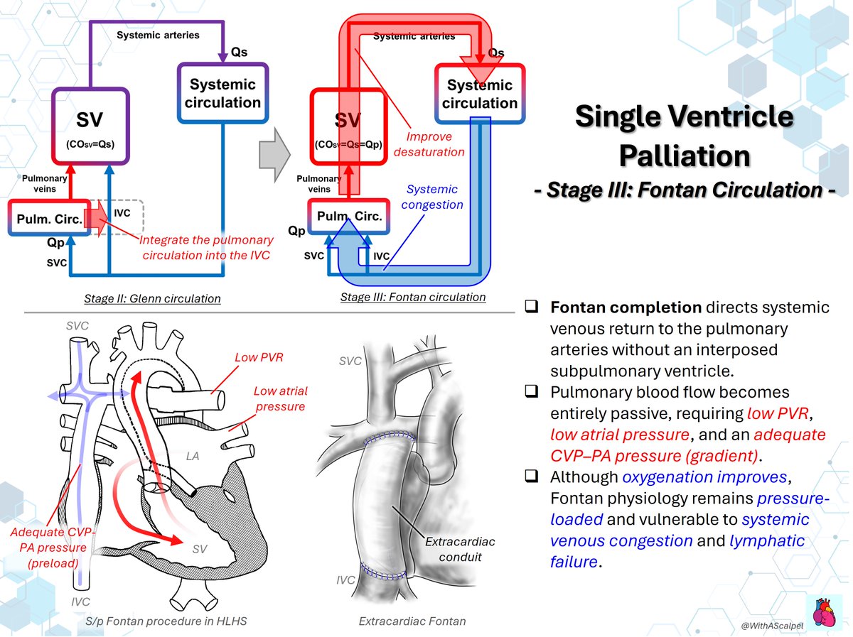 WithAScalpel's tweet photo. Single Ventricle Palliation #2: Norwood → Glenn → Fontan

👉Stage I Norwood secures systemic outflow, controlled pulmonary blood flow, and nonrestrictive atrial communication.
👉Stage II Glenn diverts SVC flow to the PAs, making pulmonary flow passive while reducing single-ventricle volume load.
👉Stage III Fontan directs systemic venous return to the PAs; low PVR and low atrial pressure are essential for flow.