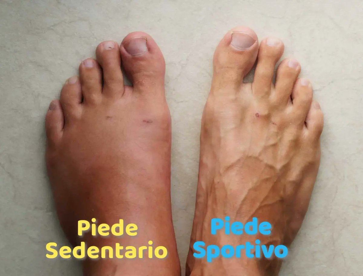 CoreenHanock's tweet photo. Visible veins aren’t always pathological or varicose veins. Clearly visible veins on the feet, along with hair on the metatarsals, suggest healthy circulation and microcirculation. In sedentary people, swelling may result from fluid retention. https://t.co/YECtLvtBlt