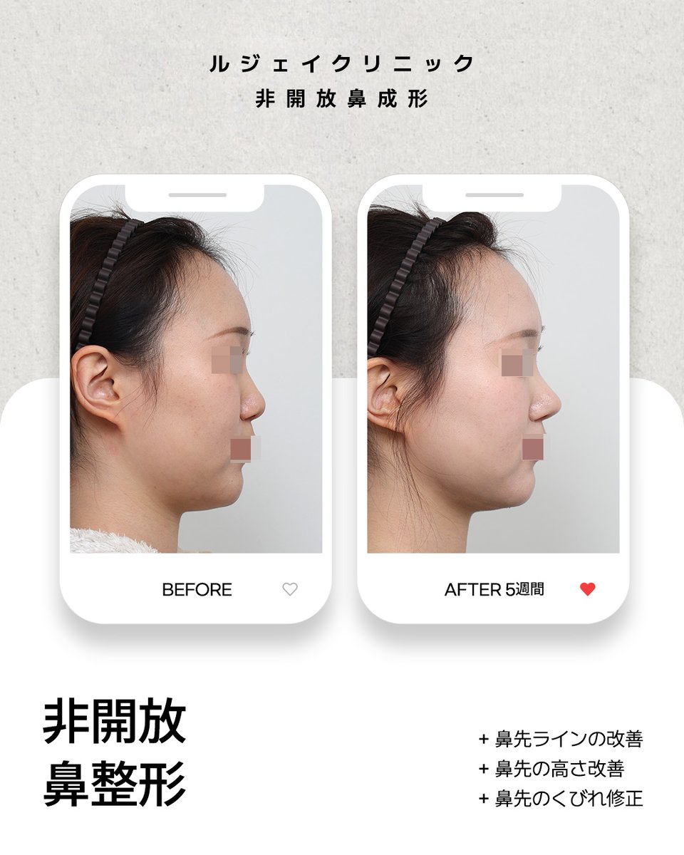 lejclinic's tweet photo. ルジェイの非開放式鼻整形は、単に鼻を高くすることだけに重点を置くのではなく、現在の鼻の構造やお顔全体のバランス、ご希望のイメージまで細かく考慮し、一人ひとりに合わせた手術プランを立てています。非開放式鼻整形が気になる方は、ぜひお気軽にご相談ください🤍#韓国鼻整形 #韓国美容整形外科 https://t.co/Dv5XbnNBc4