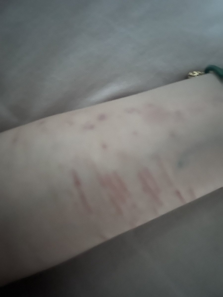 ytmmnvv's tweet photo. bruise https://t.co/BUMQSv4rGD