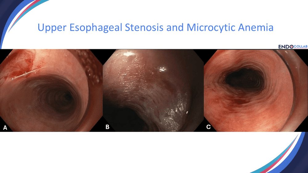 EndoCollabcom's tweet photo. Classic triad you might be missing: iron deficiency + dysphagia + proximal web. https://t.co/nWikS9xZlf