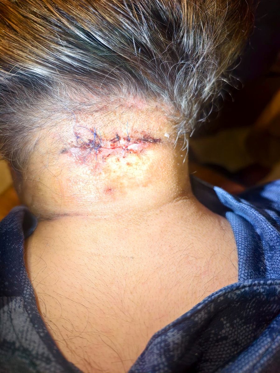 FaisalAminKhan's tweet photo. Didn’t want to share these images but some people (with questionable parentage) are making propaganda.
This is @AliAminKhanPTI who was given electric shocks at the back of his neck during custody of Punjab Police, this has been a nagging wound that he was carrying since years & eventually a surgery was done to remove it.
9 stitches on the back of the neck that’s what it is.
I have no apologies to offer & say this: Hope & pray people doing propaganda on his health or their loved ones get something like this (or even worse) to understand know how it really feels.
