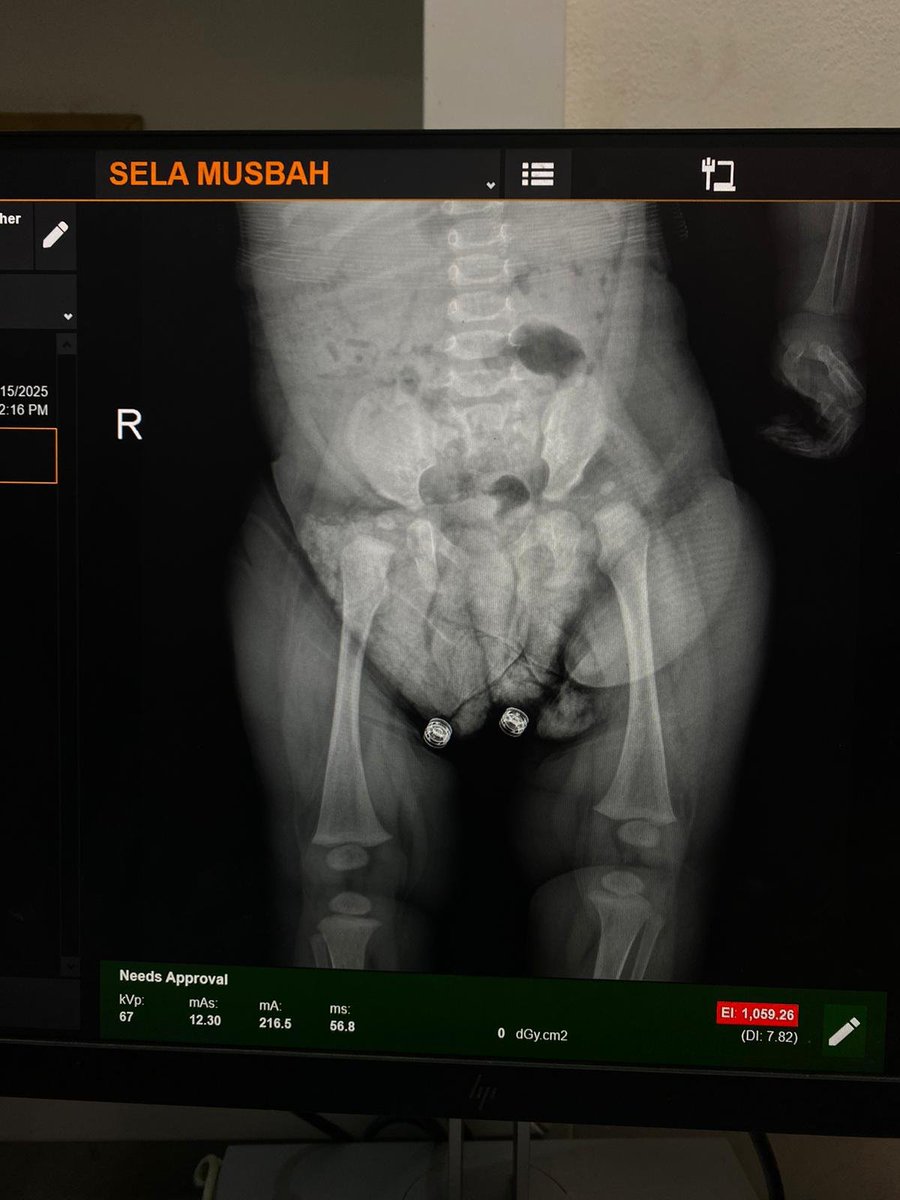 hlmmd416005's tweet photo. My friends, I trust you, you will not let me down 
My daughter urgently needs surgery costing $950. I would be grateful for any help you can offer, whether through donations, sharing, or quoting. Thank you. 
https://t.co/KkUkNqxlHU https://t.co/V98Gh2C86Q