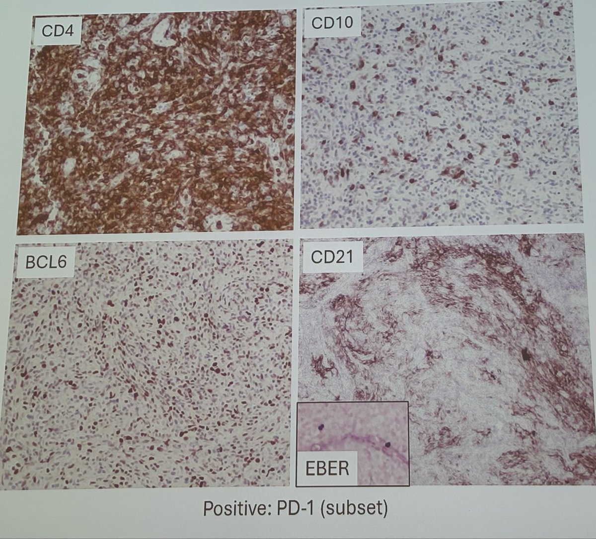 SaWangMD's tweet photo. Jessie Xu: nodal based T/NK lymphoma. From flow you can guess the diagnosis https://t.co/Mpj3lTUqkr