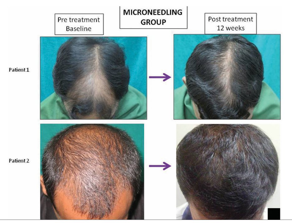 MoreDotHair's tweet photo. You're leaving free hair gains on the table if you don't do microneedling.

In this study they divided people into 2 groups.
One group did Microneedling + Minoxidil.
Second group did Minoxidil only.

Hair count increase in the microneedling group was 300% higher than minoxidil group.