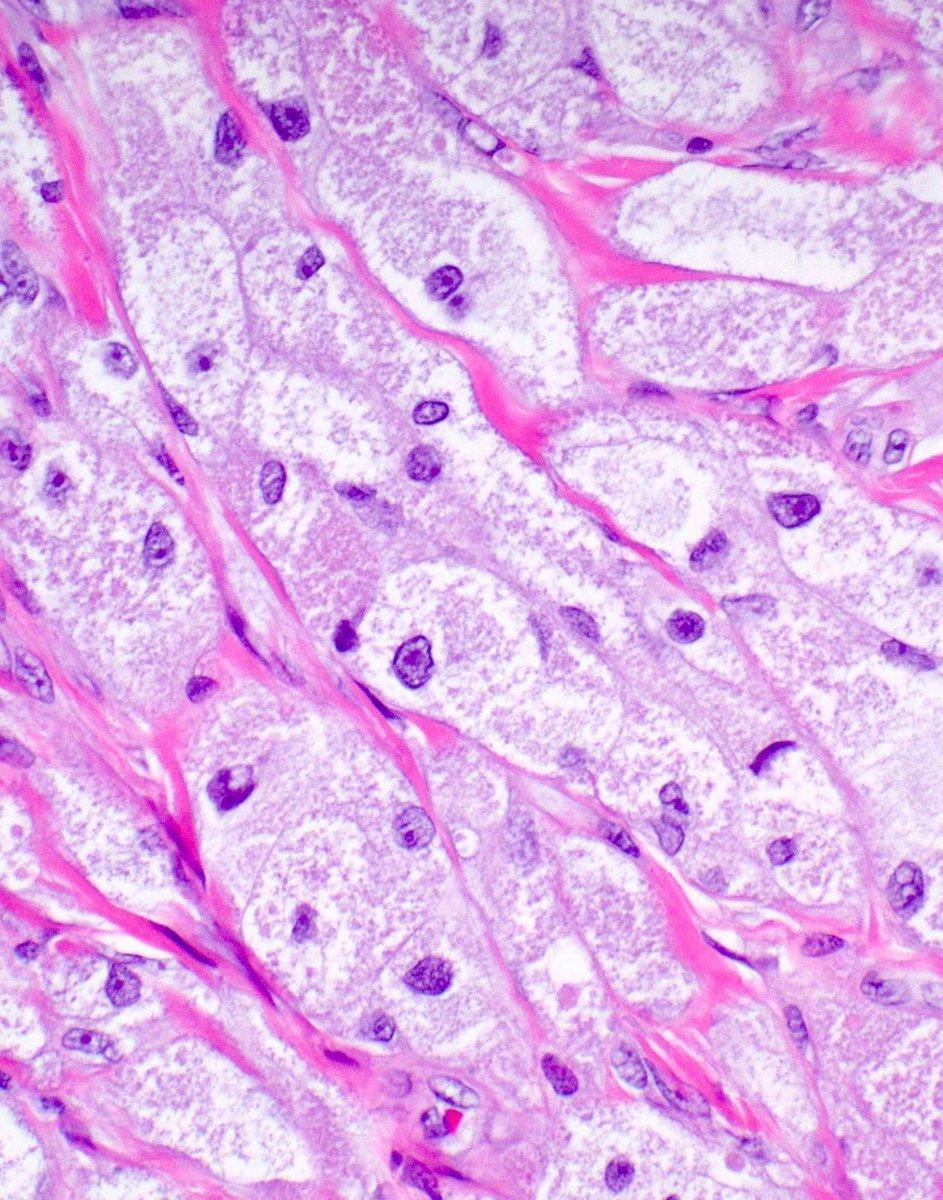 JMGardnerMD's tweet photo. 25 F back nodule. Diagnosis?
More pics🔬 https://t.co/gJRntvEQCv
Answer ✅ https://t.co/9PvjmJgx2H 
#pathology #pathologists #pathTwitter #dermpath #dermatology #dermatologia #dermtwitter #BSTpath https://t.co/bA9rBTSHgW