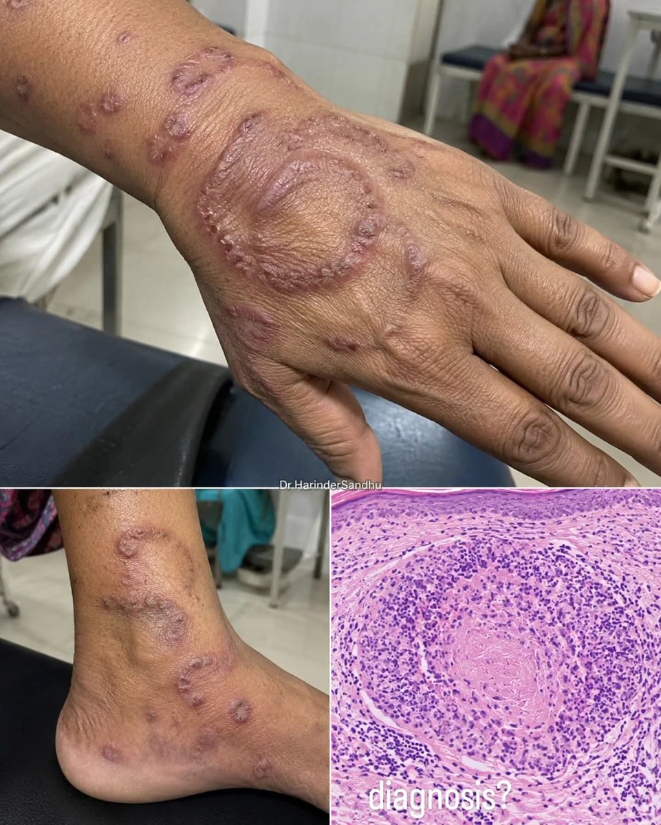 albertoortegana's tweet photo. What is your diagnosis for this 45-year-old patient with erythematous-violaceous papules and annular plaques, with biopsy showing neutrophil-rich palisading granulomas surrounding necrobiotic collagen?
Dr. Harinder Sandhu https://t.co/iz19PyLjTJ