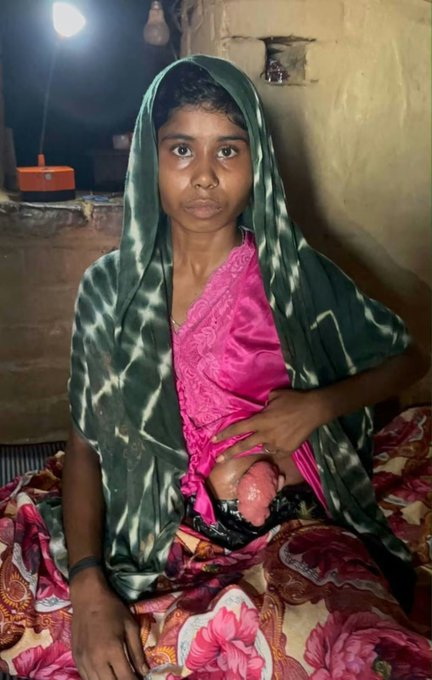 AwamiTanzeem's tweet photo. तीन साल से कैंसर से जूझ रही संजू, अब मदद की आस में…

गिरिडीह जिले के जमुआ प्रखंड अंतर्गत नवाडीह पंचायत के सखैबाद, दुम्मा निवासी राजू ठाकुर की 20 वर्षीय पुत्री संजू कुमारी पिछले तीन वर्षों से लिवर कैंसर जैसी गंभीर बीमारी से जूझ ���ही हैं।

एक बेटी को बचाने के लिए माता-पिता ने अपनी पूरी जमा-पूंजी इलाज में लगा दी। गहने जेवर बेच दी। लेकिन लगातार इलाज कराते-कराते परिवार आर्थिक रूप से टूट चुका है। अब पैसों की कमी के कारण आगे का इलाज कराना बेहद मुश्किल हो गया है।

संजू की हालत इतनी पीड़ादायक है कि बीमारी के कारण वह सामान्य रूप से शौच भी नहीं कर पा रही हैं। प्लास्टिक बैग के सहारे जीवन गुजारना पड़ रहा है। अपनी बेटी को इस हालत में देखकर माता-पिता की बेबसी का अंदाजा लगाया जा सकता है।

आज संजू के पूरे परिवार को माननीय मुख्यमंत्री श्री हेमंत सोरेन जी मदद की अपील है आपकी मदद से शायद एक गरीब की जिंदगी बच जाए कृपया संज्ञान ले @HemantSorenJMM @HelthMinistry @JPNadda @GiridihDc @narendramodi @SonuSood @tatatrusts @TataMemorial 
@JmmJharkhand 
@JMMKalpanaSoren
@IrfanAnsariMLA
@Rabindranathji
@KunalSarangi
@yourBabulal
@Annapurna_jp