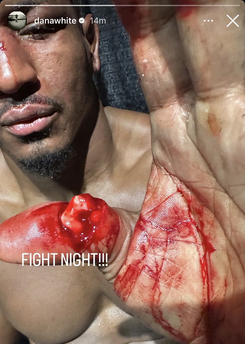 LaSueur_off's tweet photo. WWOOOWW L'ÉTAT DU POUCE DE MENIFIELD 😱

#UFC331 | via @danawhite https://t.co/fVWyZrrnVK