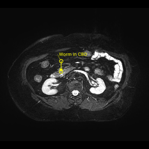 abmbbs778's tweet photo. BILIARY ASCARIASIS   [ worm in CBD] https://t.co/SPMmosN54b