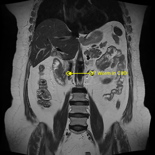 abmbbs778's tweet photo. BILIARY ASCARIASIS   [ worm in CBD] https://t.co/SPMmosN54b