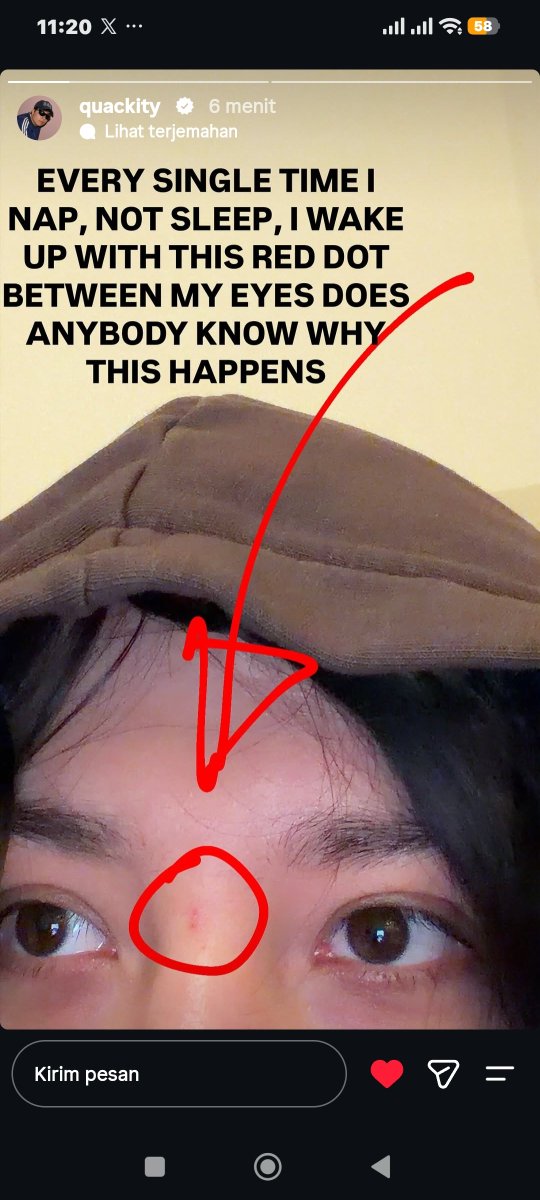 quackitymiso's tweet photo. @Quackity
@quackitytheduck
honestly fr it’s probably just a pressure mark bcs of how u rest ur head on ur hand or desk during short naps. it pinches the blood vessels but it's harmless and will fade quick https://t.co/f5EYs6CN7L