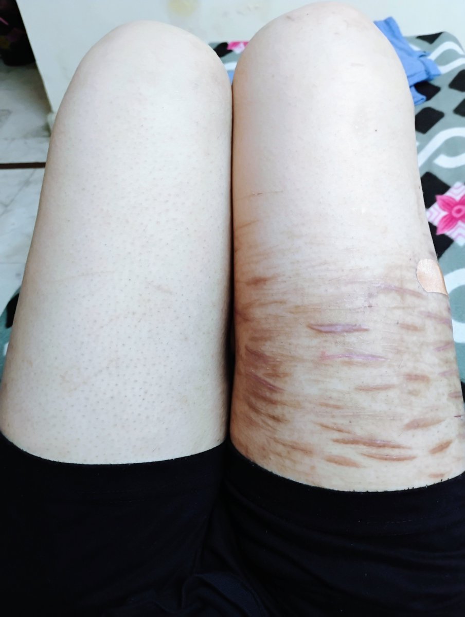 ruby_vale01's tweet photo. Sfx makeup on my right thigh.

#shed #sh #shedtwt #shtwt https://t.co/uOTwzd3R1S