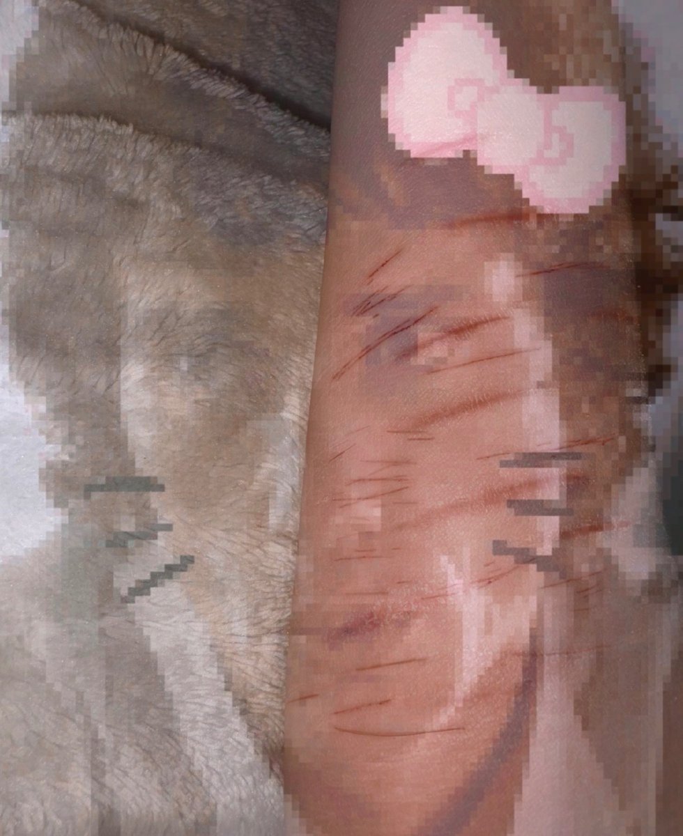 WhoseArchie's tweet photo. SFX makeup why does my arm look so fat in this photo #shedrtwt https://t.co/NWmUjuOknB