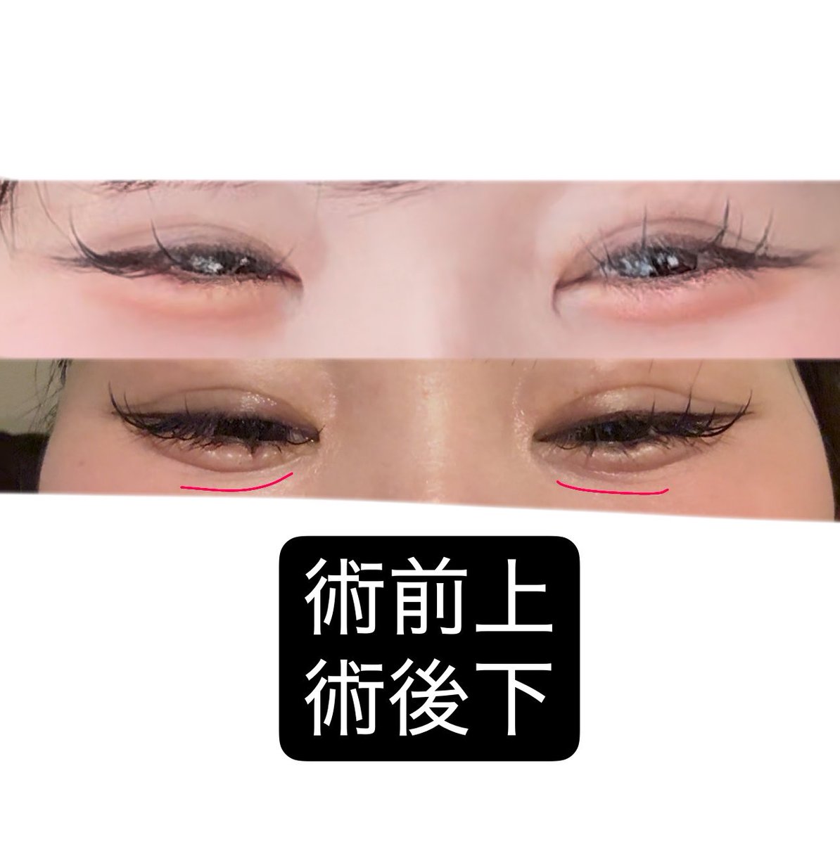 d1x_c's tweet photo. 外科的涙袋形成DT9日目(涙袋脂肪移植済)
笑った時に二重に線ができるのが悩み😔
右側の線の薄さ、ガタ付きに加えて予定外線でも悩むことになるとは、、

修正日は決めたからこれ改善されるといいなあ
同じ施術を検討されてる方の参考になれば嬉しいです😔
こんなパターンもあります😭
#外科的涙袋形成 https://t.co/ratEjfPGy5