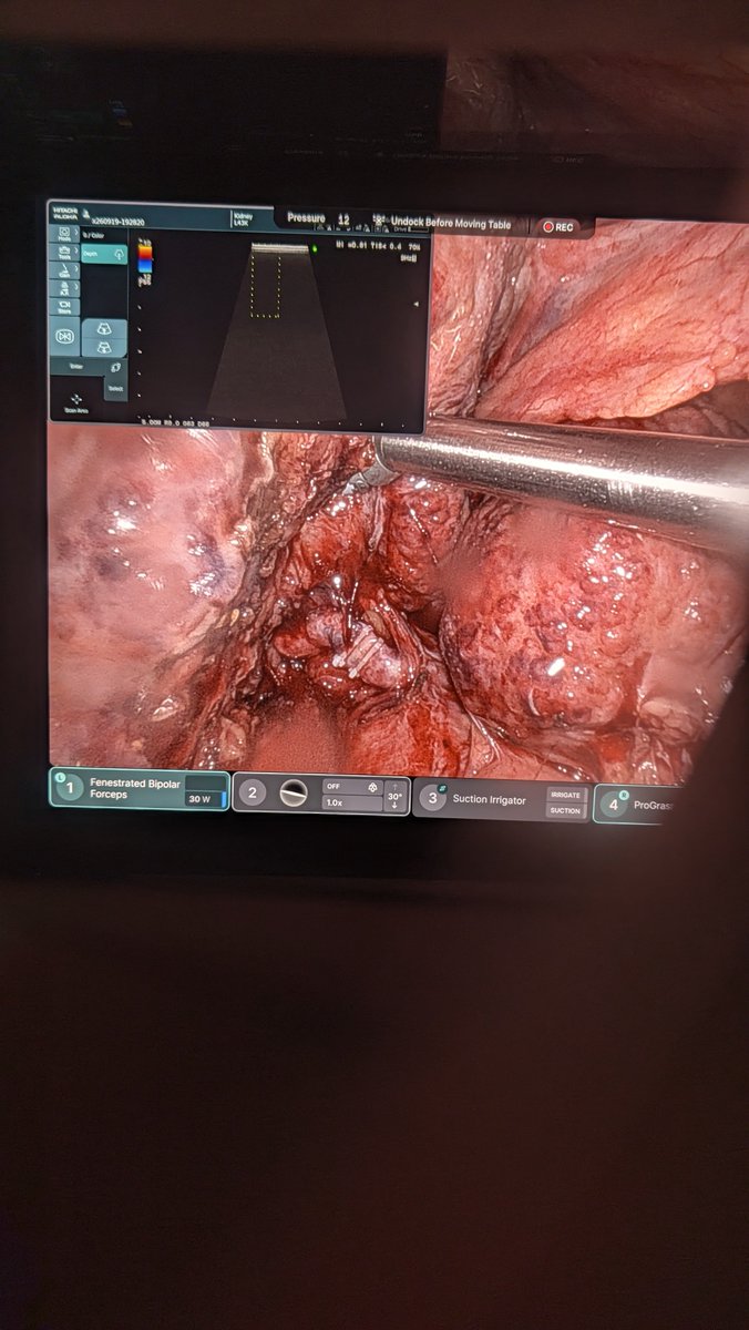 Robo_HPB's tweet photo. Surgical ligation of right hepatic artery for actively hemorrhaging massive ruptured HCC after ICG verifying adequate left sided arterial perfusion (IR not available anywhere inside a 100 mile radius). What would you have done? https://t.co/kSH6MxbZSr