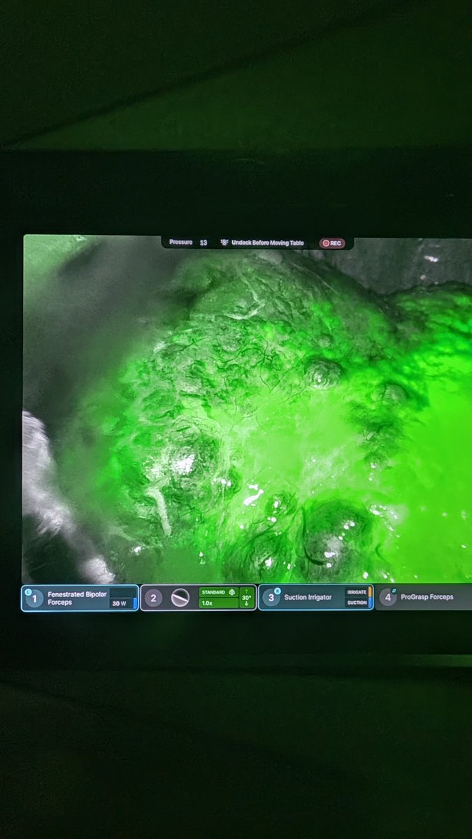 Robo_HPB's tweet photo. Surgical ligation of right hepatic artery for actively hemorrhaging massive ruptured HCC after ICG verifying adequate left sided arterial perfusion (IR not available anywhere inside a 100 mile radius). What would you have done? https://t.co/kSH6MxbZSr