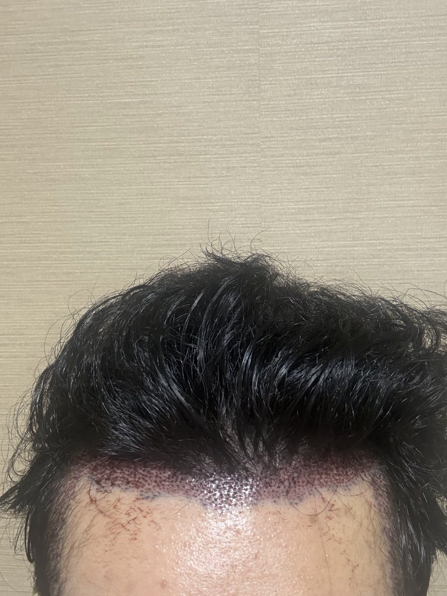 h0vkzn's tweet photo. モエムクリニックさんで植毛してきました。
手術翌日の状態。
シャワーして上がった状態。
生え際、後頭部の感覚は鈍いけど痛くない！ https://t.co/adeUO0SRfO