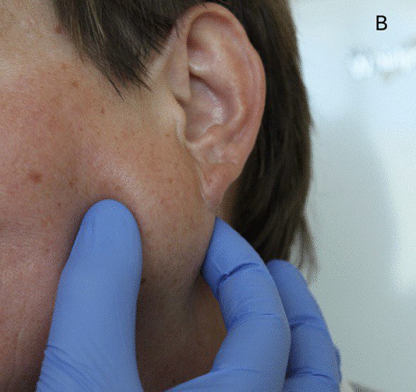 abdulhamid_199's tweet photo. سوال 
دائما يتكرر في البورد الامريكي  
والاغلب راح يجاوبه خطأ 

ايش ال Nerve 
اللي يخلي ال parotid gland تفرز اللعاب ؟ https://t.co/Wrm86w5lPw