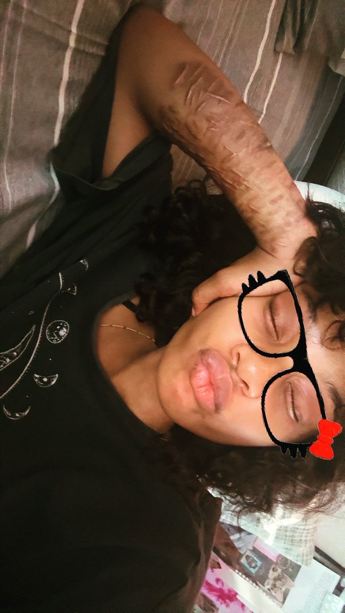 nitencyy's tweet photo. TYYYY FOR 60 FOLLOWERS 🥹🥹 
Face reveal 👹TW:Ugly ,scars https://t.co/mJB0VG2klE