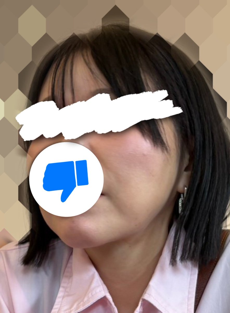 LIFESUCKS_111's tweet photo. 内視鏡リフト（フェイスラインリフト）の現実。夢は全くないです😃悪夢です😃
マリオネットライン解消したくてやった結果がこれなの、あまりにもひどすぎる😃金返してくれたら助かる😃もっとうまいとこでやり直せるから😃 https://t.co/Ef4bN4x4BX