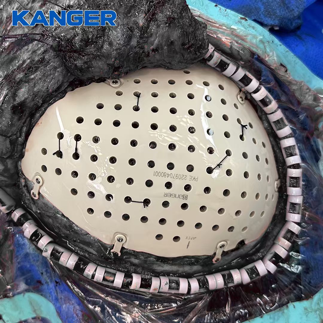KangerMedical's tweet photo. 🧠 Cada defecto craneal es único.

Un implante de PEEK personalizado, diseñado según la anatomía del paciente.

📩 crystal@kangeryl.com

#KANGR #PEEK #Craneoplastia https://t.co/e16LtLIGrt