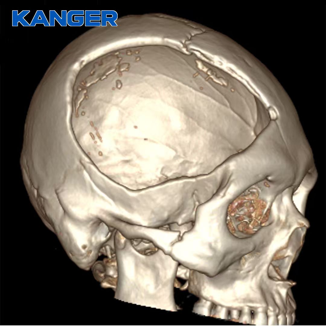KangerMedical's tweet photo. 🧠 Cada defecto craneal es único.

Un implante de PEEK personalizado, diseñado según la anatomía del paciente.

📩 crystal@kangeryl.com

#KANGR #PEEK #Craneoplastia https://t.co/e16LtLIGrt