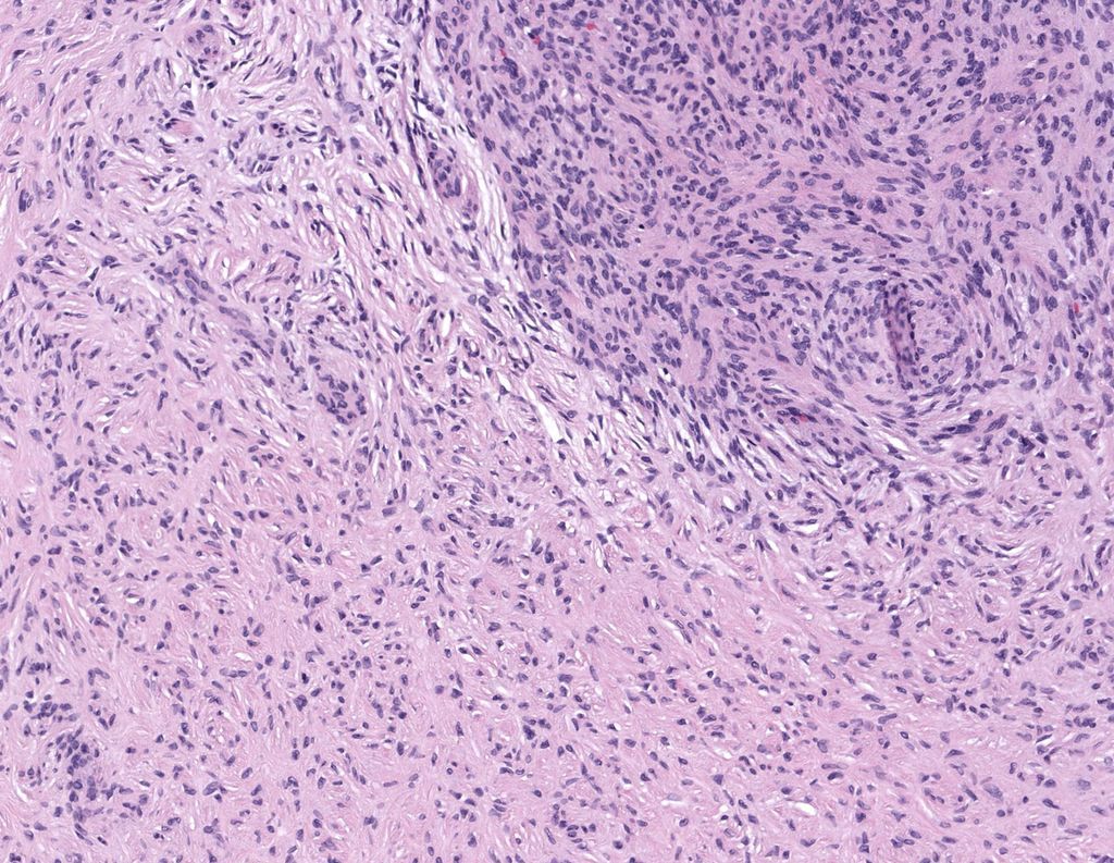 JMGardnerMD's tweet photo. Finger. Clinical dx: cyst. Stain: CD34. Your diagnosis? 
Answer ✅ https://t.co/9g4AqdZ2D6 
WSI digital slide 🔬 https://t.co/68kZ4m5XB9 
More stains: https://t.co/MZe1eBo0vc 
#pathology #pathologists #pathTwitter #dermpath #dermatology #dermtwitter #BSTpath https://t.co/wG2wJRKZ1v