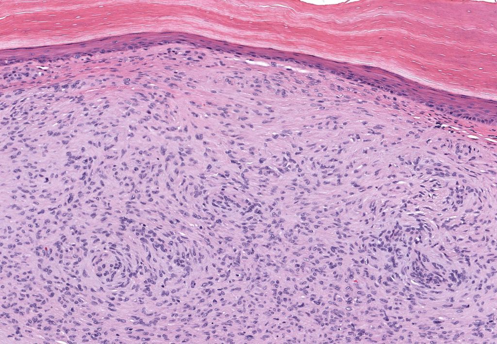 JMGardnerMD's tweet photo. Finger. Clinical dx: cyst. Stain: CD34. Your diagnosis? 
Answer ✅ https://t.co/9g4AqdZ2D6 
WSI digital slide 🔬 https://t.co/68kZ4m5XB9 
More stains: https://t.co/MZe1eBo0vc 
#pathology #pathologists #pathTwitter #dermpath #dermatology #dermtwitter #BSTpath https://t.co/wG2wJRKZ1v