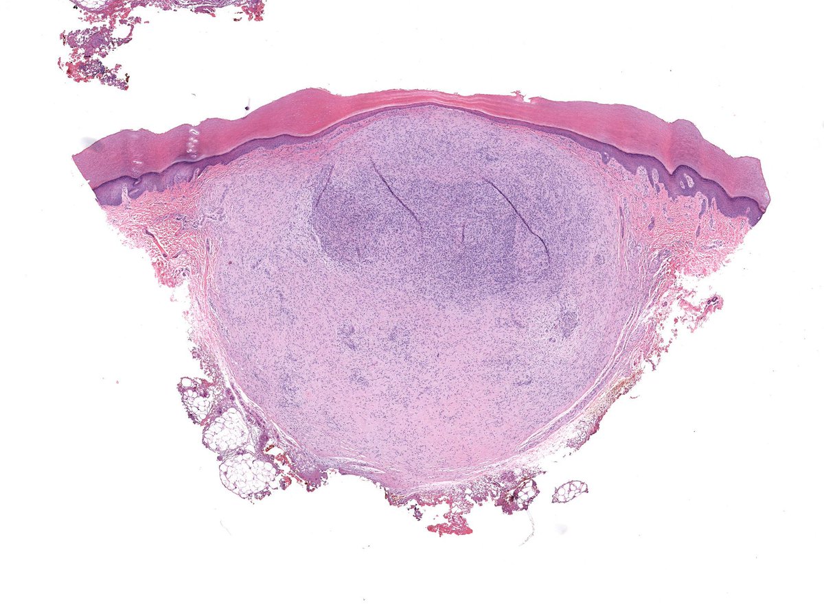 JMGardnerMD's tweet photo. Finger. Clinical dx: cyst. Stain: CD34. Your diagnosis? 
Answer ✅ https://t.co/9g4AqdZ2D6 
WSI digital slide 🔬 https://t.co/68kZ4m5XB9 
More stains: https://t.co/MZe1eBo0vc 
#pathology #pathologists #pathTwitter #dermpath #dermatology #dermtwitter #BSTpath https://t.co/wG2wJRKZ1v