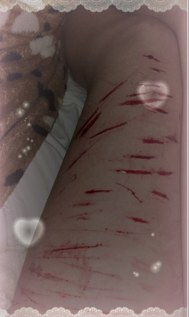 jadlem37694's tweet photo. Okay guys this is my second account. My first one got suspended!! 
Dont remember if this was cat scratches or styros. 
SFX makeup!! 
#shedtwt #slittwt #ouchtwt #shtwt https://t.co/J2m10fZtCd