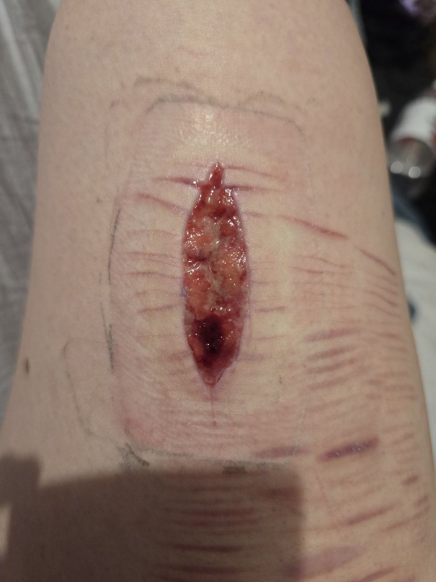 itttskayla's tweet photo. Hi guys is this normal for healing beans #shtwtt https://t.co/yBOH7xHrlI