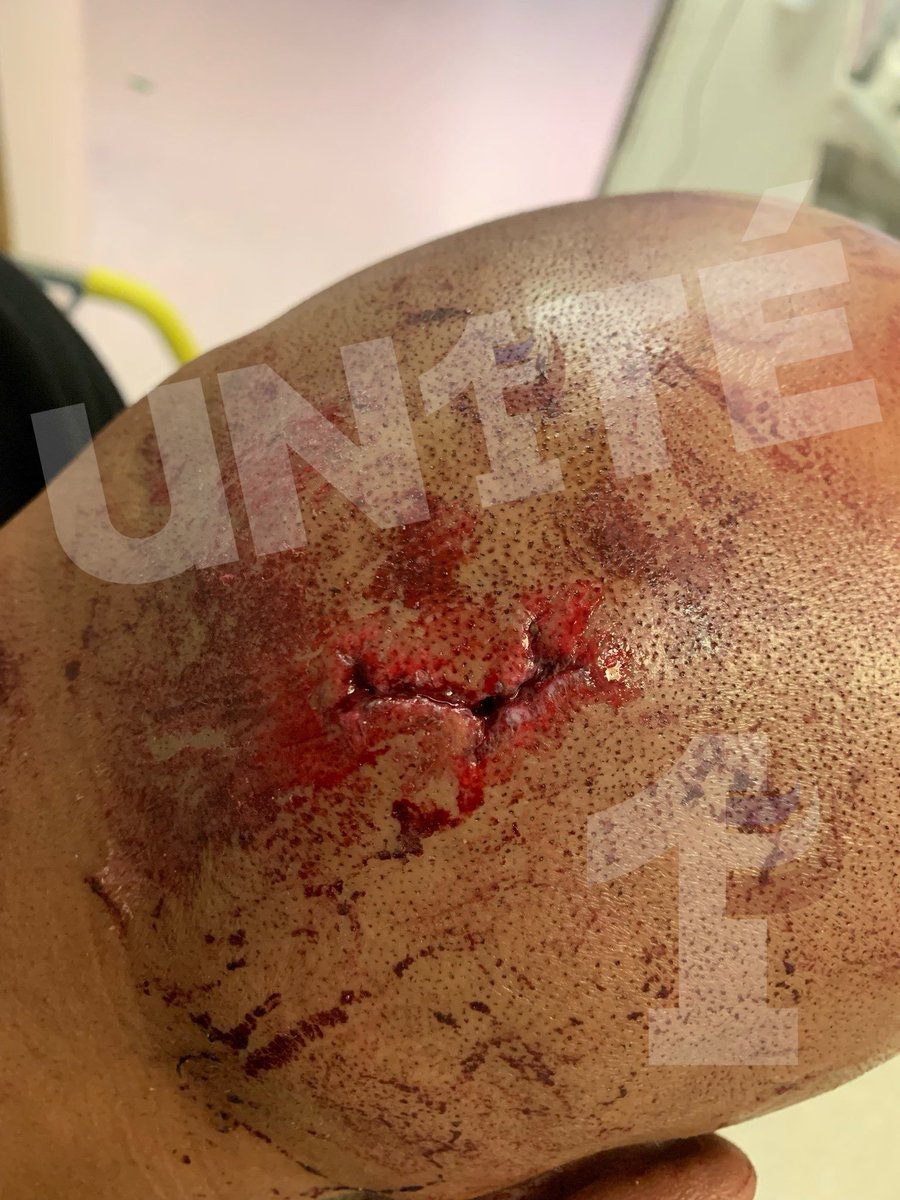 UN1TE_policenat's tweet photo. Saint-Pierre-des-Corps.

Voici la réalité derrière ce chiffre.
📞 Intervention à la suite d’un appel 17.
🧱 Un collègue reçoit un pavé en pleine tête.

Pendant que certains parlent des interventions de police, nos collègues, eux, les vivent et parfois dans leur chair.

#UN1TÉ https://t.co/O4gGpffxTy