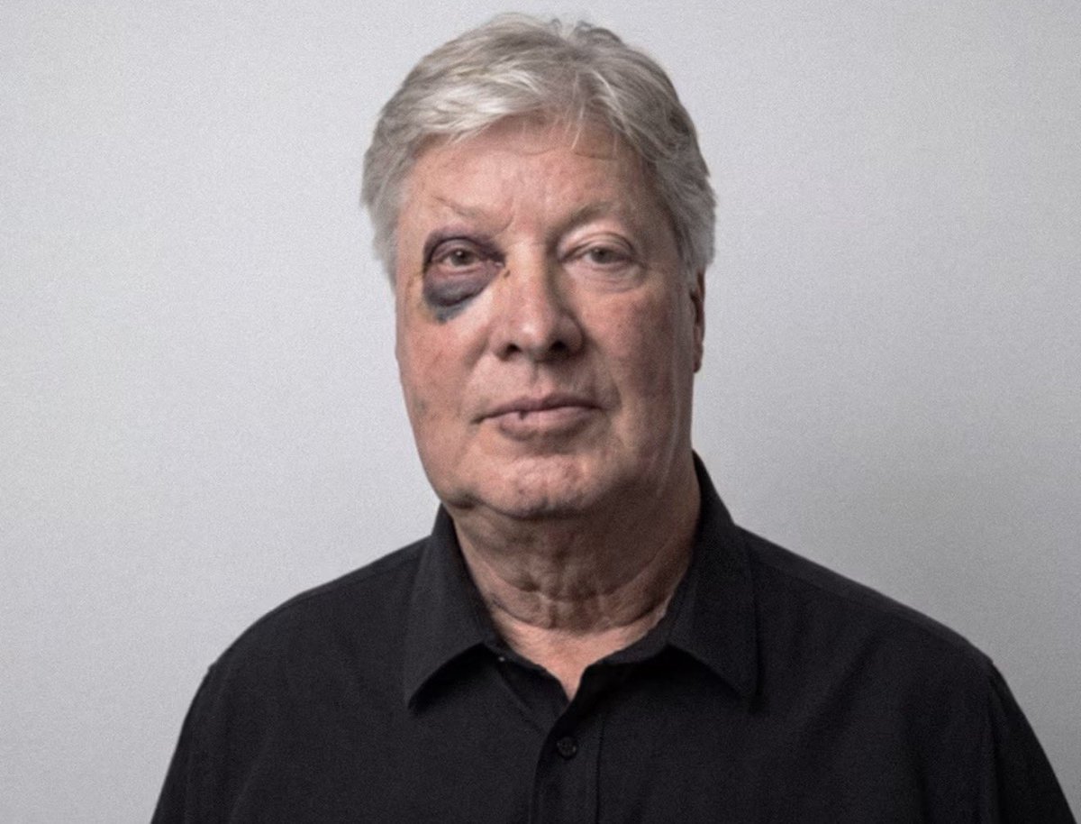 beyond_theveil1's tweet photo. Trump's former spiritual advisor, Robert Morris, has officialy joined the  the Black Eye Club. https://t.co/TrVAyddGjs