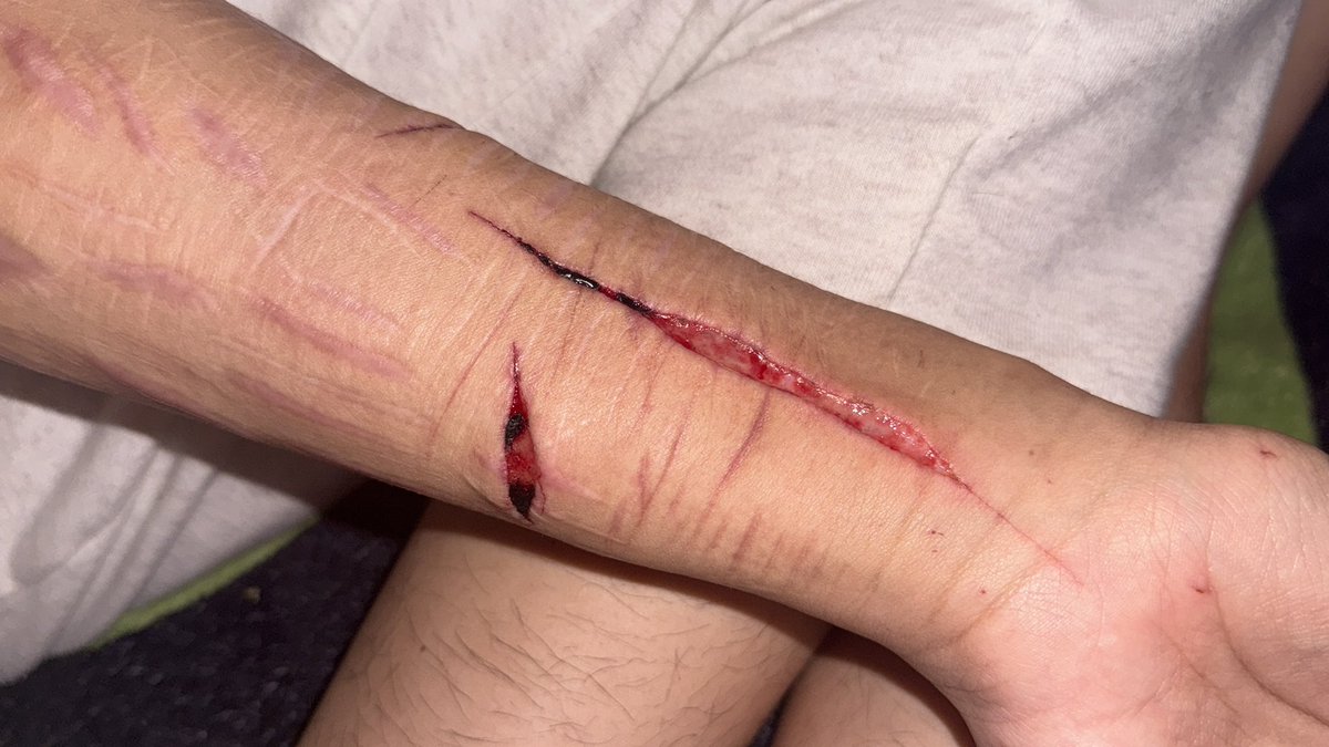 xC4ndY_H34RtXx's tweet photo. #healing 
SFX MAKEUP I promise 
#fakeinjury https://t.co/tXR0IN3fGo