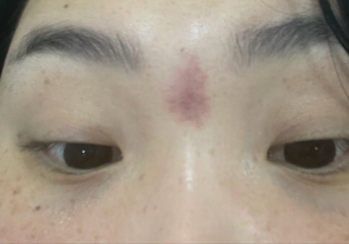 Namimmi1's tweet photo. Throwback to the time I did an all day stuffing challenge for 3 days on telegram and got a small vessel leak between my eyebrows on end of day 3….. https://t.co/1MVSPVYMW5