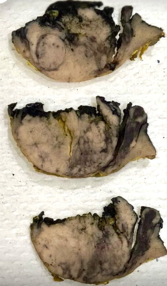vintage81106614's tweet photo. The art of grossing.A 78 yo man with a HO ofprostate cancer. Left renal tumor (2.8x2.6cm) found during routine FU.FinalDx.Cromophobe RCC.#pathologists #pathresidents #GUpath #pathTweeter https://t.co/Tfc9eojtTz