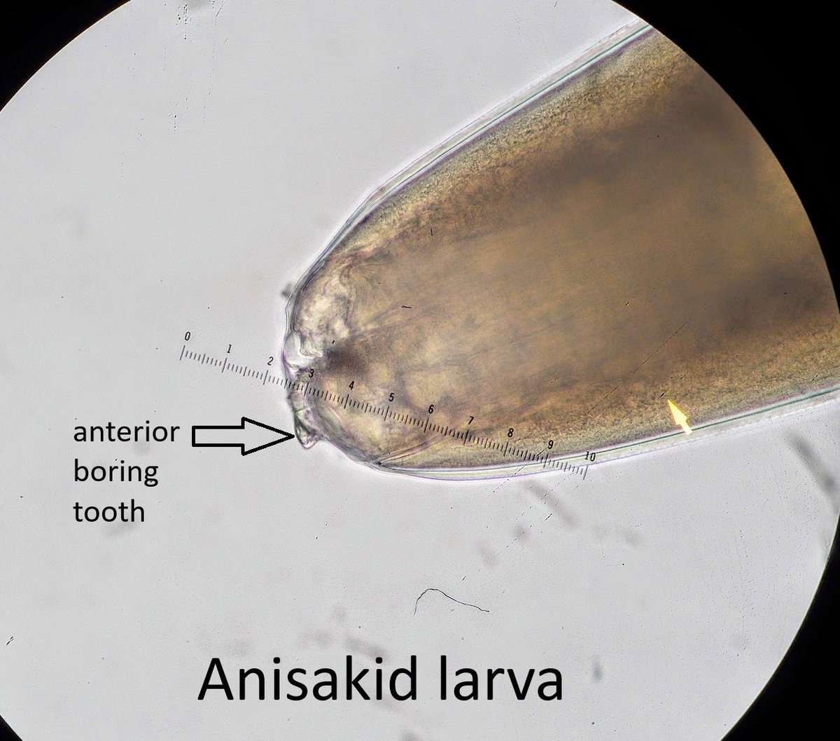 ParasiteGal's tweet photo. The answer to #ParasiteCase 818 is up: anisakid larva! 🪱🐟
Check out the full post for the key morphologic features—including the boring tooth and mucron—and learn how these fish-associated larvae are identified:
https://t.co/wtD59gnVY4
#PathBugs #Parasitology #Pathology #MayoPath