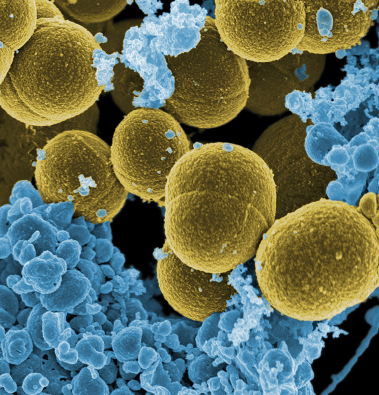 Bacteria Staphylococcus aureus escapando de la destrucción por células blancas humanas