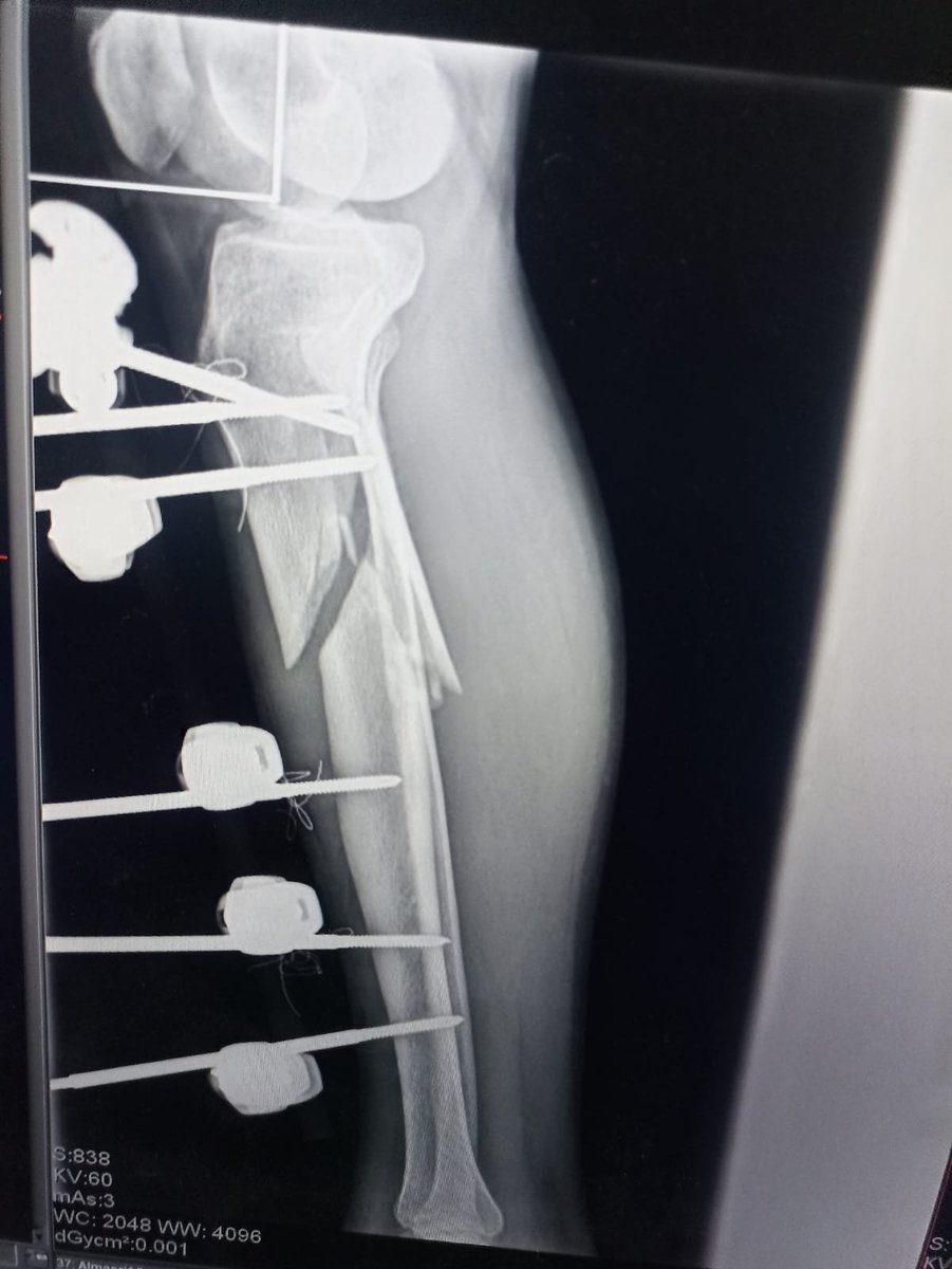 SAlmsry38871's tweet photo. I am Sanad from Gaza, and I urgently need surgery. The cost is $700.
I need your help to cover the cost of my operation. Any donation, no matter how small, can make a big difference in my life. 🙏💔
Please help me. Thank you from the bottom of my heart.
https://t.co/TMaNkazR7Y https://t.co/xRkrvaS5dX