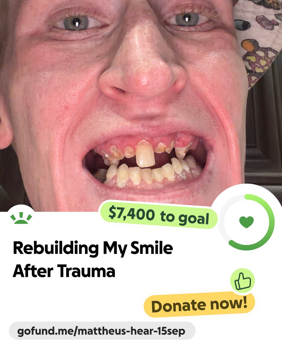 WillB2Willin's tweet photo. @GoFundMeCharity 

Hi everyone. I’m raising money to get the dental care I desperately need after suffering severe dental trauma. I’ve already had several damaged teeth removed, but I still have a long way to go and the cost of repairing and replacing my teeth is over $25,000. https://t.co/hNSFMqjY6n