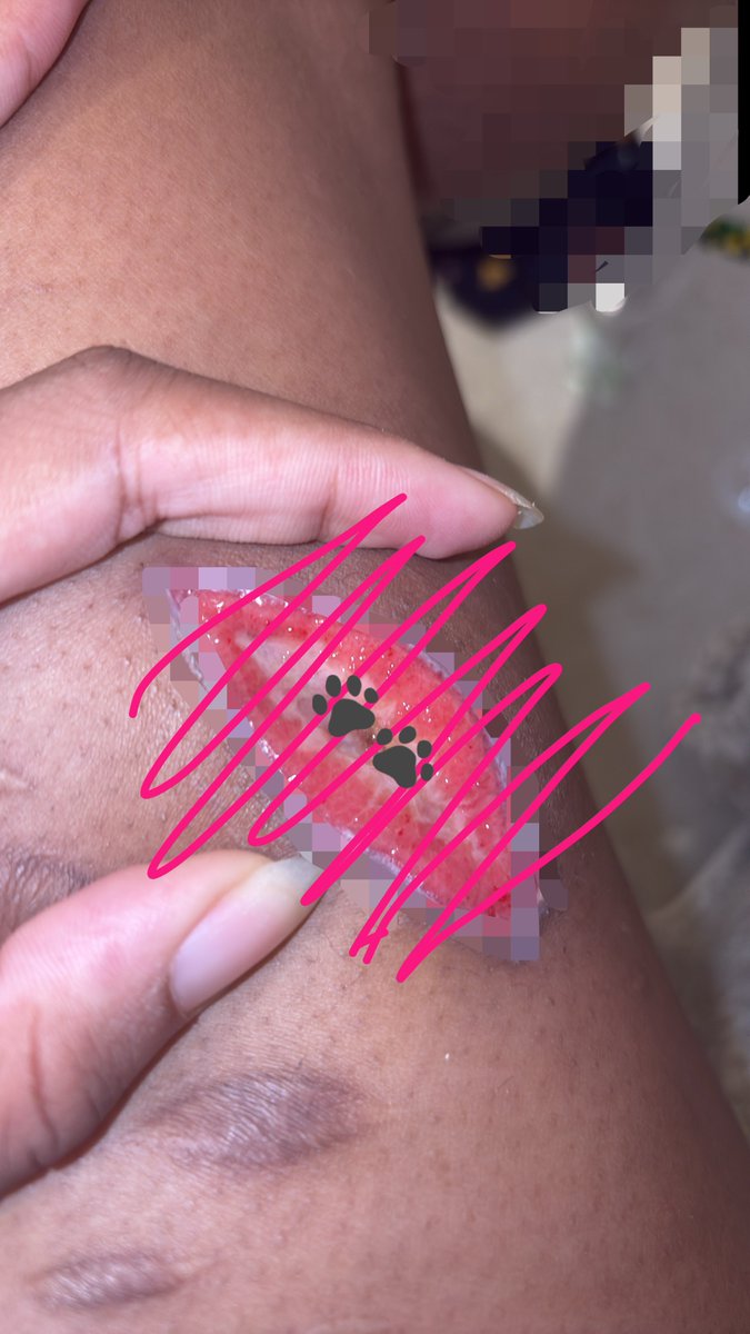 waterisdogg's tweet photo. oh thats... appetizing... right...

tw // healing

so i shaved and fucking got hair in it, then sliced my foot like wtf. fucking hate ts 🫩

shrtwt beanstwt fasciatwt redinktwt https://t.co/WhymrZg1H1