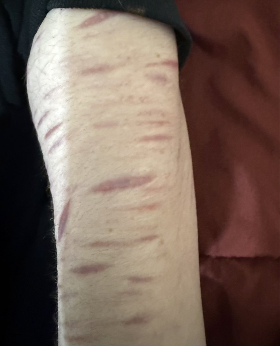 Foreverrtired07's tweet photo. My arm scars (Fully healed)
#shedtwtt #988twt #shtwtt https://t.co/HvkZTnvMih