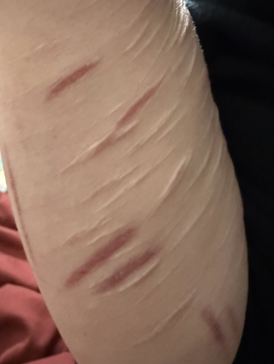 Foreverrtired07's tweet photo. My arm scars (Fully healed)
#shedtwtt #988twt #shtwtt https://t.co/HvkZTnvMih