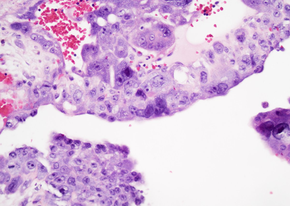 GuannanTiffany's tweet photo. 🧩 Testis riddle

Three diagnostic clues: the background, the cytoplasmic color, and how many cell types are present.

What would you consider?
#DxMindMap #TestisPath #GUPath #PathTwitter @JHUpath @MGBpathology https://t.co/WhRfpWWJjj