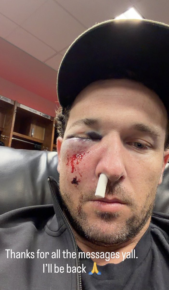 beisboltimes's tweet photo. Así quedó el ojo de Alex Bregman tras ser golpeado por una pelota de foul mientras esperaba su turno para batear 

🥴⚾️ https://t.co/Oc9xCmEJPY