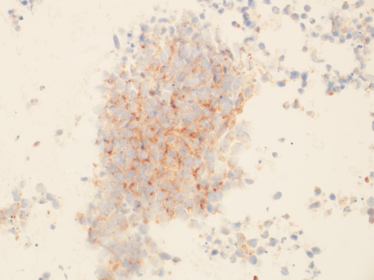 CytoPapGuy's tweet photo. Small cell carcinoma, positive staining for DLL3. Gorgeous example. 

#pathtwitter #pathology #cytology #cytopathology #medschool #path #pathologyresidency https://t.co/vyQcs6E4b9