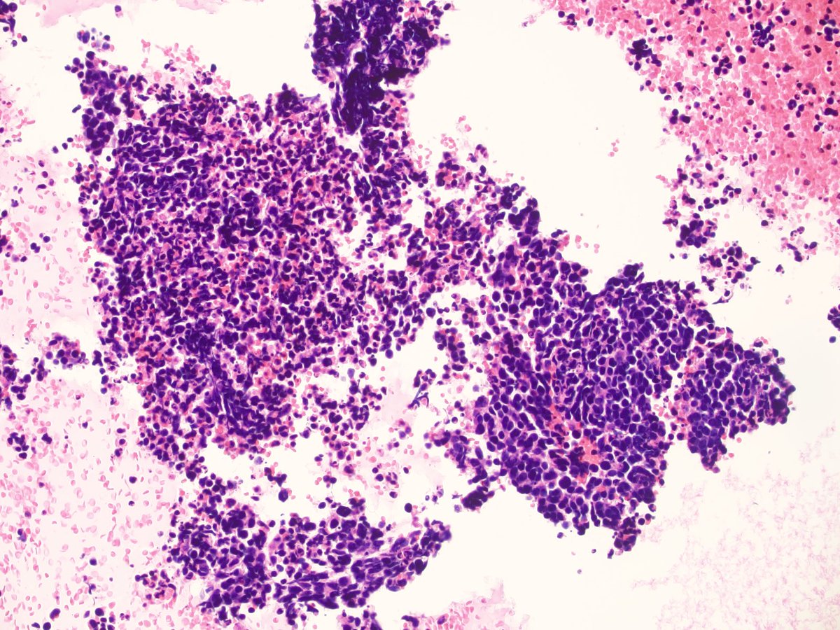 CytoPapGuy's tweet photo. Small cell carcinoma, positive staining for DLL3. Gorgeous example. 

#pathtwitter #pathology #cytology #cytopathology #medschool #path #pathologyresidency https://t.co/vyQcs6E4b9